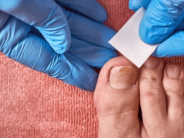 fungal toenail treatment in upland, ca