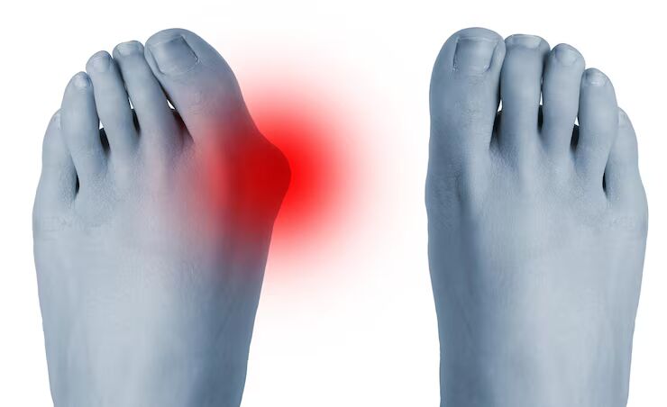 Illustration of bunion and hammertoe